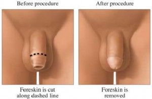 circumcision2